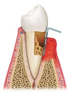 rendering of a tooth with gum disease